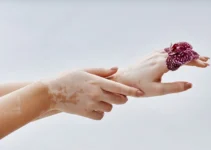 پیسی یا ویتیلیگو چیست؟ 11 روش درمانی و مراقبتی آن را بشناسید